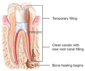 diagram of endodontic retreatment