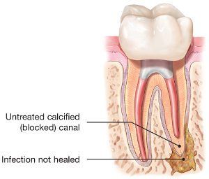 diagram of endodontic retreatment