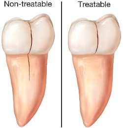 diagram of a treated tooth and non-treated tooth