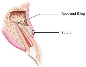 diagram of apicoectomy