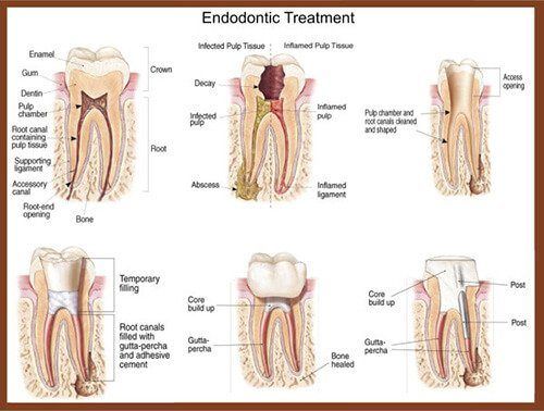 diagram of an endodontic treatment